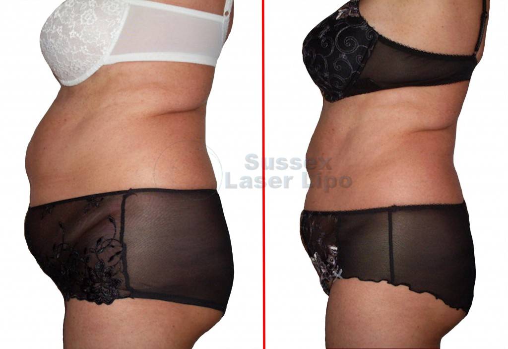 accelerated-laser-lipo-inch-loss-before-and-after-1