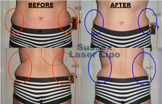 accelerated-laser-lipo-inch-loss-before-and-after-2