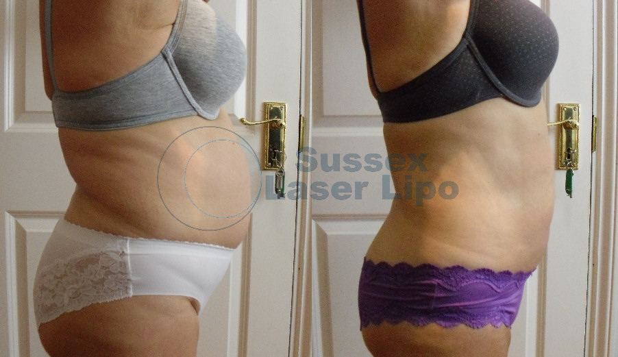 accelerated-laser-lipo-inch-loss-before-and-after-7
