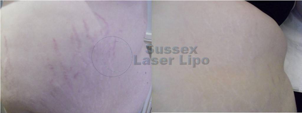 stretch-mark-reduction-before-and-after-1