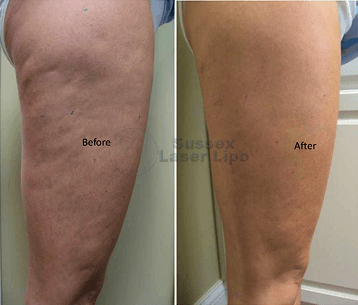 ultimate-cellulite-before-and-after-1