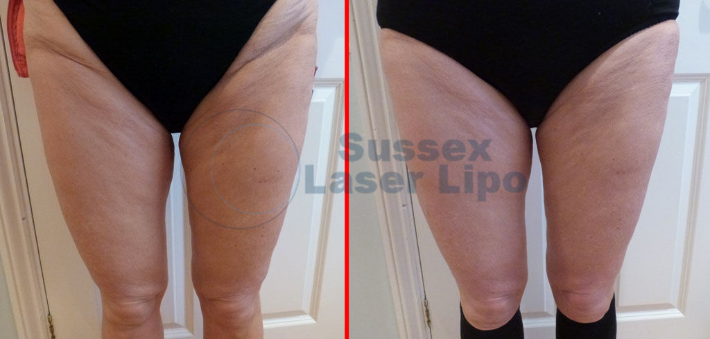 Ultimate-Cellulite-results-1
