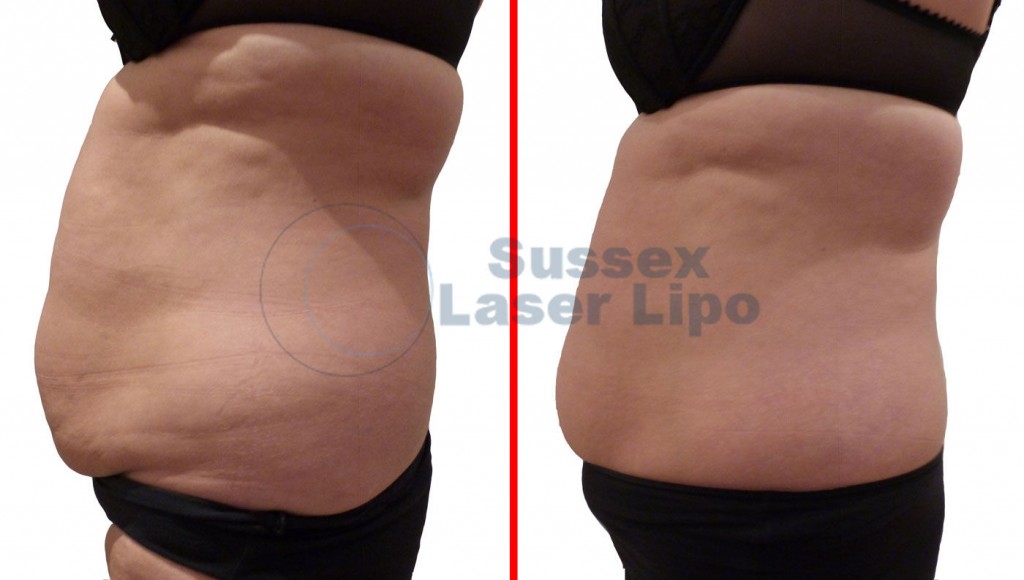 accelerated-laser-lipo-results-1