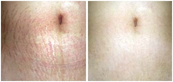 Stretch-Mark-Reduction-Sussex-Laser-Lipo (2)
