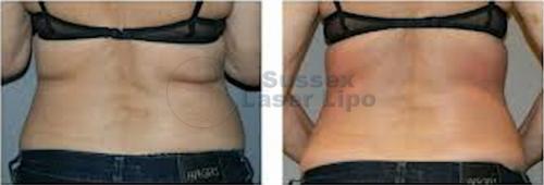 Cryogen Fat Freezing Inch Loss Results 7