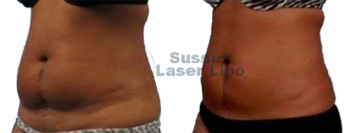 Cryogen Fat Freezing Inch Loss Results 8