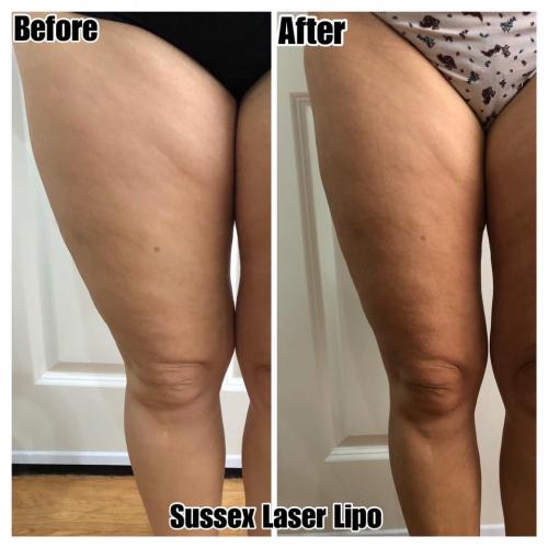 Accelerated Laser Lipo