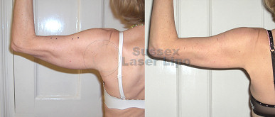 Cryogen Fat Freezing Inch Loss Results 9