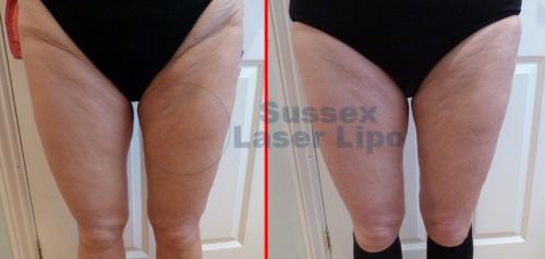 Ultimate Cellulite Results 1