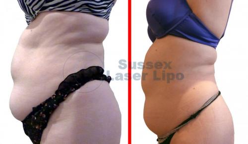 Cryogen Fat Freezing Inch Loss Results 2