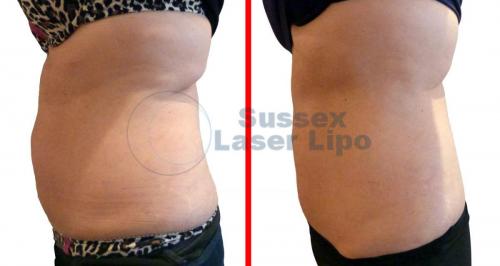 Cryogen Fat Freezing Inch Loss Results 3