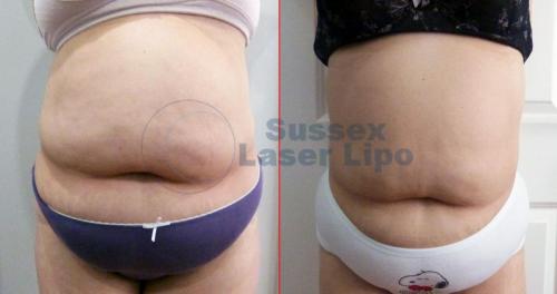 Cryogen Fat Freezing Inch Loss Results 4