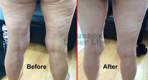 Ultimate Cellulite Results 2